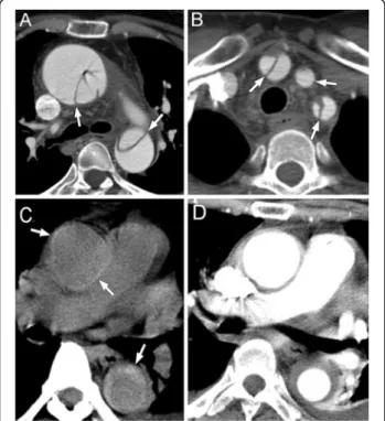 Figure 1 Dissection type. (A) Classic type A aortic dissection with visible intimal flap (arrow) inside dilated ascending and descending aorta