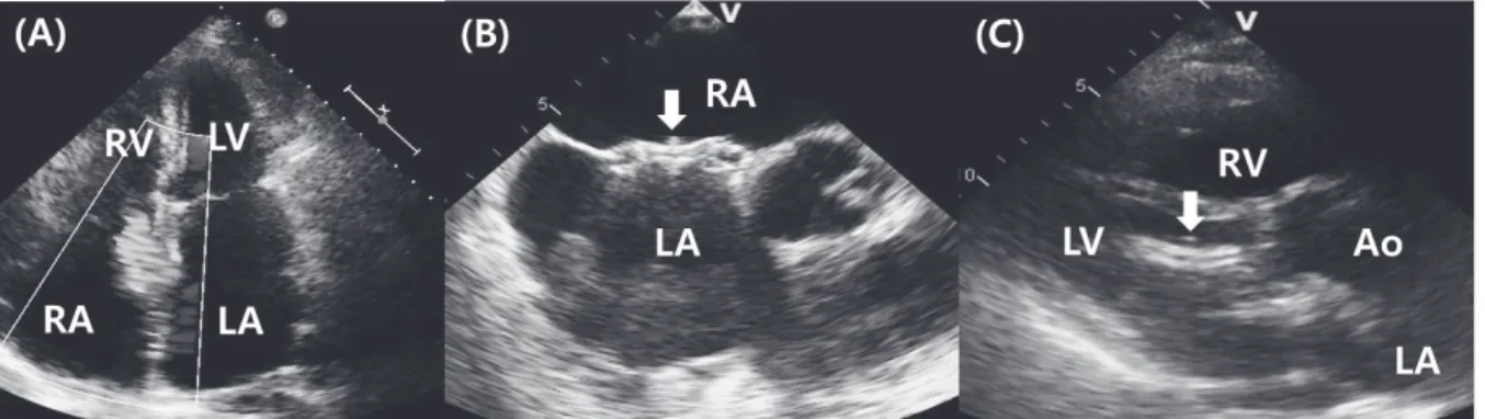 Fig. 1. (A) Secondum type ASD with left to right shunt flow. (B) successful deployment of ADO (arrow)