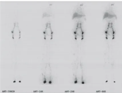 Fig. 1 is a typical case of normal ymphoscinti- ymphoscinti-graphy, as a reference case.