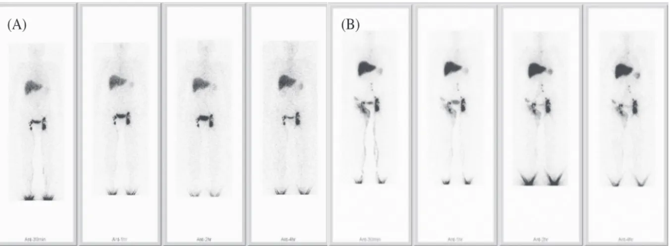 Fig. 9. 53-year-old female suffered from intermittent right lower extremity swelling for 1 year