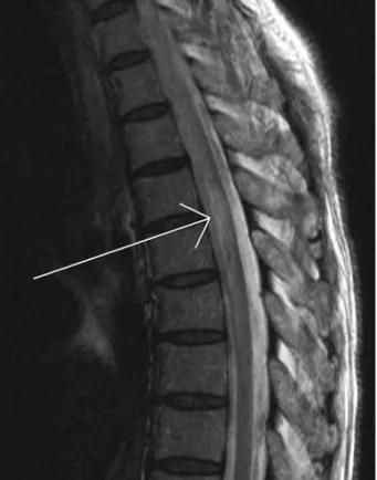 Figure 2. T2-weighted cervical spinal MRI. There are  diffuse high intensity lesion in cervical and thoracic  spinal cord from C2 to T6 level.