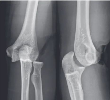 Fig. 2.  Initial plain radiographs show posterior dislocation of the elbow. 