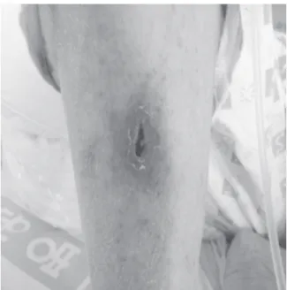 Fig. 1. About 0.5×1.5 cm sized dark brown-colored  eschar is shown in the anterior area of right lower  leg.