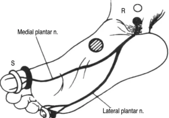 Figure 1. Position of the stimulating and recording electrode for sensory nerve conduction of the plantar nerve.