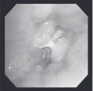 Fig. 2. Chest computed tomography shows  bronchial wall thickening associated atelectasis at  left lower lobe (white arrow).