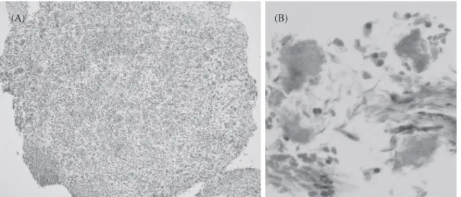 Fig. 4. (A). Bronchoscopic biopsy specimen shows granulomatous necrotic tissue surrounded by inflammatory cell  (H &amp; E stain, original magnification ×100)
