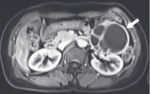Fig. 1. Magnetic resonance imaging shows a 76 × 62 × 84 mm sized, cystic mass in the left upper abdoniminal cavity  (arrow).