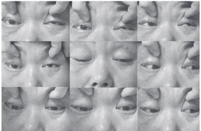 Fig. 1. Right eye shows complete ptosis, complete limiation on lateral and upward gaze, and partial limitation on  medial and downward gaze