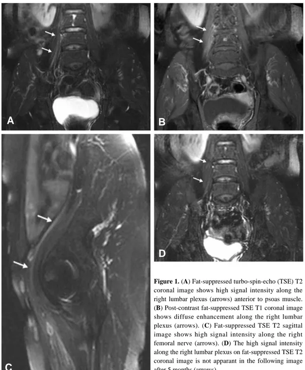 Figure 1. (A) Fat-suppressed turbo-spin-echo (TSE) T2 coronal image shows high signal intensity along the right lumbar plexus (arrows) anterior to psoas muscle.