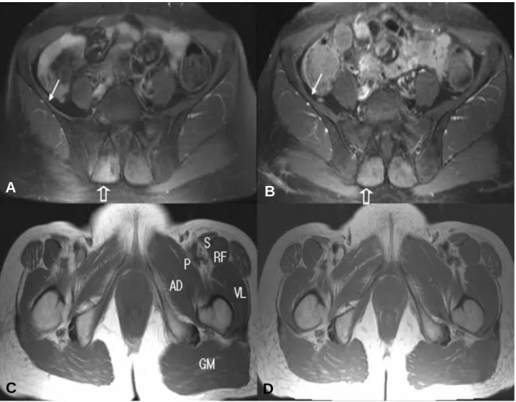 Figure 2. (A) Fat-suppressed turbo-spine-echo T2 axial image shows severe atropic change in right iliacus muscle (solid arrow) and increased signal intensity in right posterior paraspinal muscle (open arrow) in S1 level initially