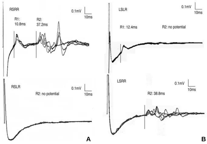 Figure 3. Note a high signal lesion in the ponto-medullary junction area on diffusion weighted MR imaging (arrow)