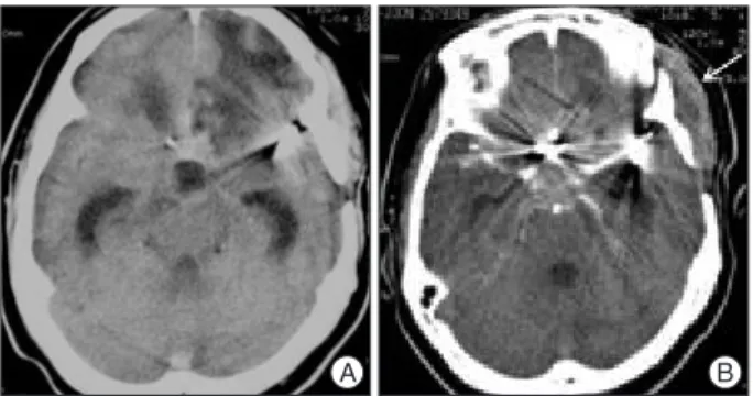 Fig. 1. Computed tomography of a textiloma developed after pterional  craniotomy for aneurysm clipping