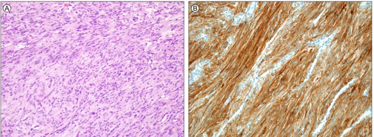 Figure 4. Microscopic and immunohistochemical findings of the tumor. (A) The tumor comprised spindle-shaped cells with mitoses  (H&amp;E stain, × 200)