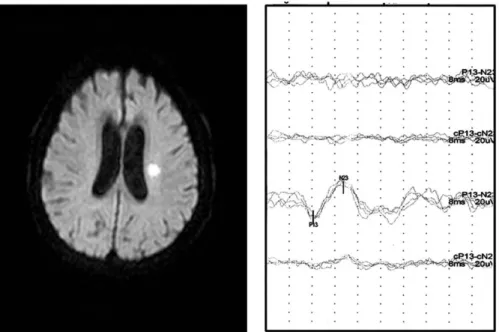 Figure 1. Examples of vestibular evoked myogenic potential abnormality in supratentorial stroke patients