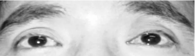 Figure 1. Left dilated pupil is non reactive to light and right miotic pupil is induced by instillation of a diluted  parasympath-omimetic agent.