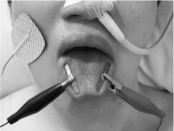 Figure 1. Position of the stimulating electrode of the hypoglos- hypoglos-sal nerve. The hypogloshypoglos-sal nerve was stimulated at a point 1/3 distance along the inferior surface of the mandible from angle to the apex and 1 cm medial to the inner aspect