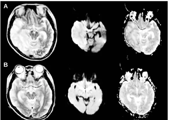 Figure 1. A and B Brain MRI (T2 weighted image, diffusion weighted image, ADC map, in order of figure)