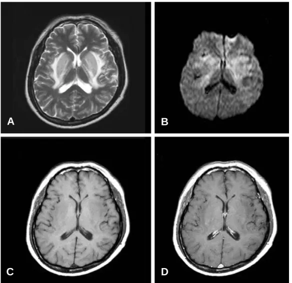 Figure 1. (A) T2 weighted MRI images show extensive hyperintensity over basal ganglia bilaterally, extending to the adjacent periventricular white matter