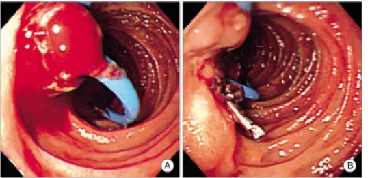 Figure  2.  ERCP  finding.  It  shows  a  remnant  round  filling  defect  at  the  distal  common  bile  duct  (arrow).