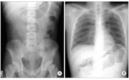 Figure  5.  MRI  finding.  It  reveals  irregular,  uneven  thickening  of  the  GB  wall.