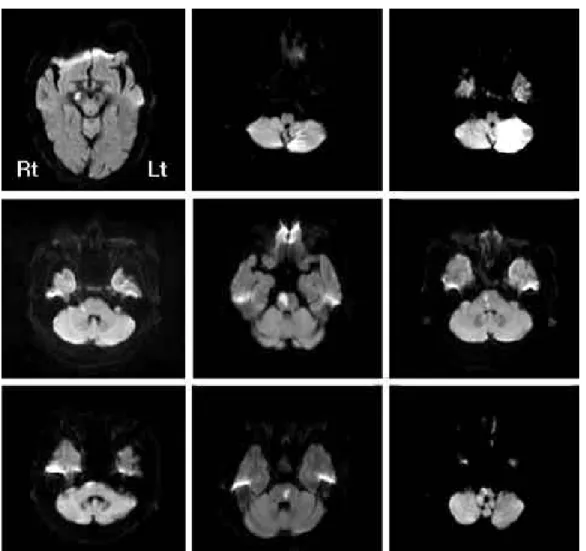 Figure 3. Diffusion weighted MR images of patients who showed contralateral VEMP abnormalities according to the lesion(2 pons, 1 medulla lesion).