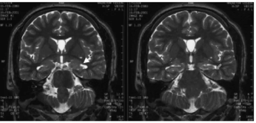 Figure 1. Brain MRI of the patient. Coronal T2 weighted images show high signal intensity and atrophy in the left hippocampus  (arrow)