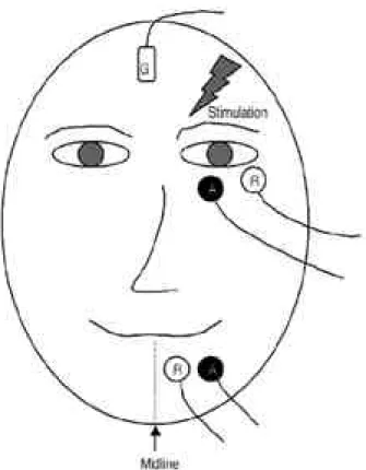 Figure 1. Applied blink reflex test: G; ground, A; active sur- sur-face electrode, R; reference sursur-face electrode.