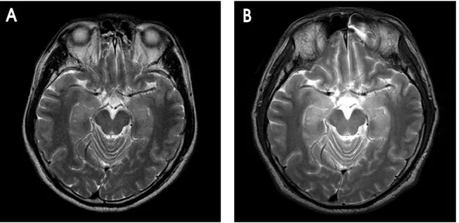 Figure 1. A T2 weighted MR axial image performed on the first hospital day. (A) shows no abnormal findings