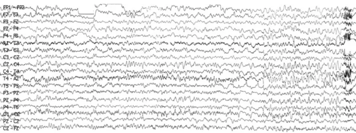 Figure 2. EEG recorded during status epilepticus on the 6th hospital day. Note that rhythmic delta activities arising from the right  posterior temporal area spread to the whole cerebral hemisphere.