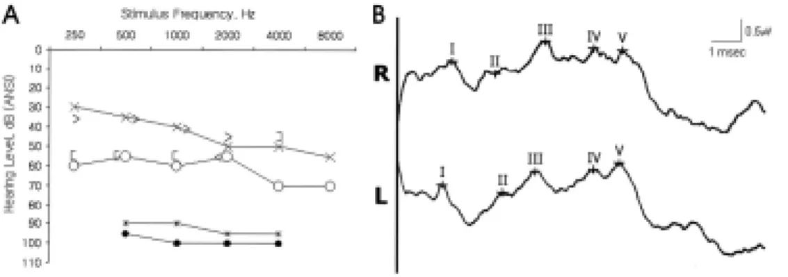 Figure 2. Brain MRI 2 days after onset of symptoms. T2-  weighted and diffusion-weighted axial images showed a tiny  infarct in the right lateral tegmentum of the lower pons.