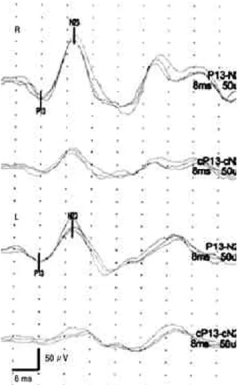 Figure 3. 100dB(nHL) tone burst to each ear evoked normal p13n23 potentials in the ipisilateral sternocleidomastoid  mus-cles.