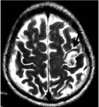 Figure 1. MRI of the patients. T2-weighted image shows high signal intensity in the left precentral gyrus.