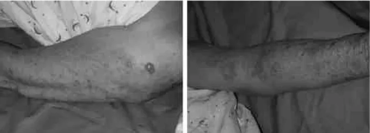 Figure 2. A high signal was seen in left motor cortex on T2-weighted image (A) and diffusion-weighted image (B) of brain MRI.