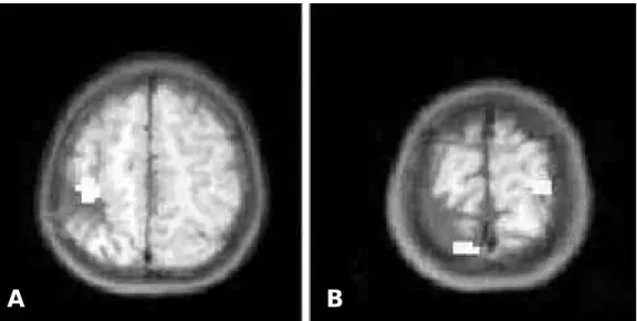 Figure 2. The fMRI showed activation of the perilesional contralateral cortex, by the affected hand stimulation (A)