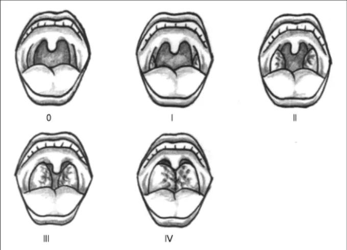 Fig. 2. Illustration of tonsil grades：Grade 0, Grade I, Grade II,  Grade III and Grade IV