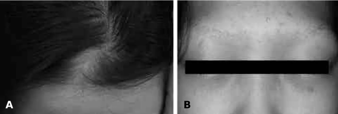 Figure 1. Seven months before diagnosed with myasthenia gravis, her hair and eyebrows had begun to disappear