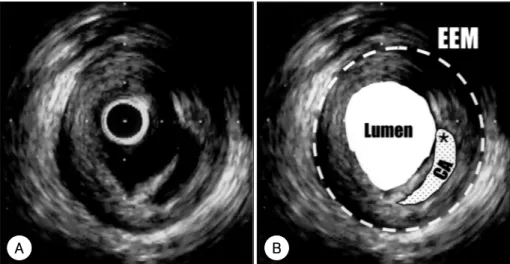 Fig. 1. IVUS image showed echolucent area at 3 to 6 o’clock that communicated with lumen with an overlying residual fibrous cap (A)
