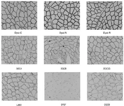 Figure 1. The immunohistochemical finding of dysferlinopathy (LGMD2B). The immunoreactivity against dysferlin is selectively lost