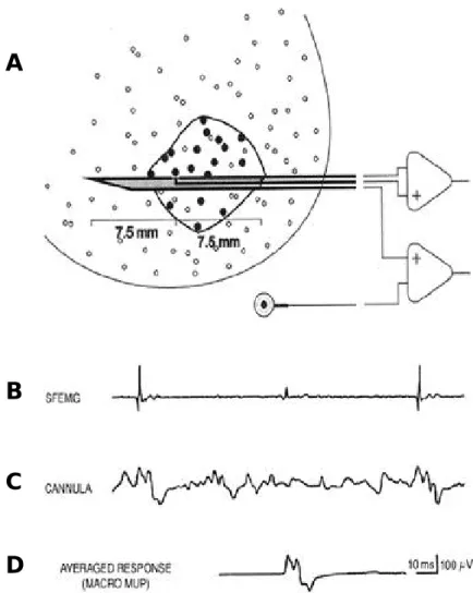 Figure 6. Macro electromyography. Schematic description of recording principle. A. The modified single-fiber electromyographic (SFEMG) electrode with distal 15-mm bare cannula inserted into the muscle