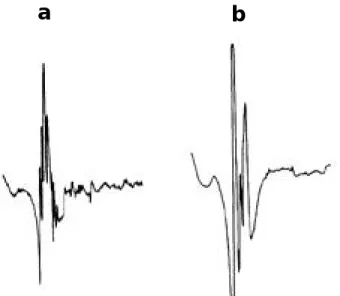 Figure 3. Examples of superimposed MUPs from a control sub- sub-ject (upper) and a patient with ALS (lower)