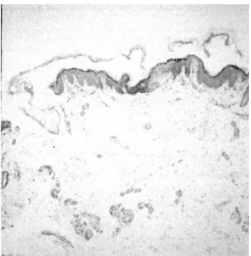 Fig. 1. The skin with diffuse erythematous rash and ruptured bullous lesion among small vesicle.