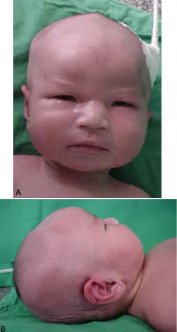 Fig. 1. Face of the patient (A) shows macorcephaly, hyperte- hyperte-lorism, down slanting palpabral fissure, low nasal bridge, long philtrum, left low set ear