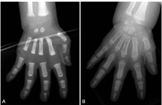 Fig. 3. Anteroposterior view of right hand at 2nd days of life (A) revealed two carpal bone ossification centers compatible with bone age of 6 months