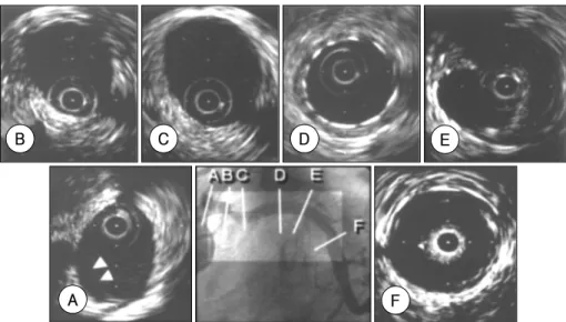 Fig. 4. Final coronary angiography after removing the gui- gui-dewire revealed no lumen stenosis of the proximal portion and good expansion of the stented segments in the LCx