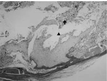 Figure 1.  Chest CT shows a huge, well-enhanced mediastinal tumor containing multiple nodular calcifications and abundant vascular components.