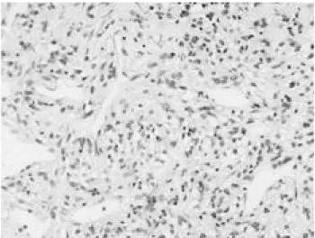 Figure 3.  Histopathologic study shows bundles of malignant smooth muscle fibers containing spindle-shaped nuclei (H&amp;E,