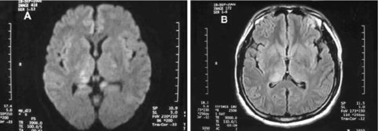 Figure 1. Brain MRI. Bilateral. Rt side prominent, thalamic high signal intensity on Diffusion MR imaging (A), and T2-weighted MR imaging (B)