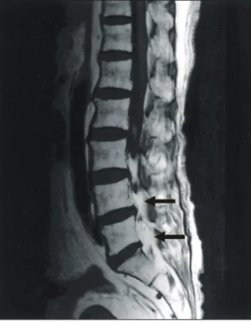 Fig.  2.  Sagittal  T1-weighted  MRI  image  revealed  increased  epidural  fat  deposition  in  L3-S1  level  that  was  hyperintense  in  signal  and  causing  the  lumbar  thecal  sac  compression.