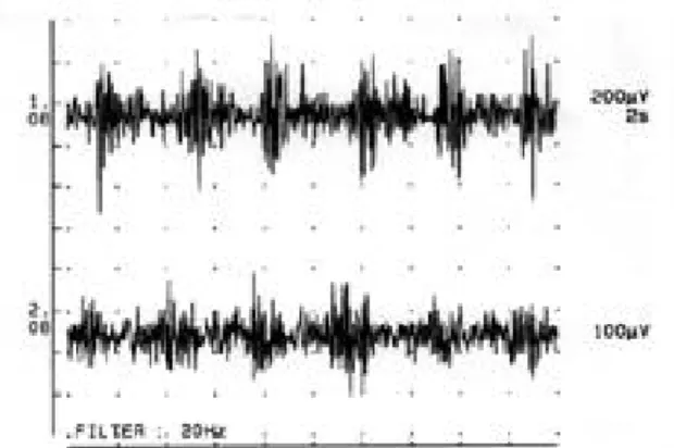 Figure 4.  Alternating (60%) and co-contracting (40%) EMG activities at 3 Hz frequency were recorded from both finger flexor and extensor muscle groups of the right upper extremity.