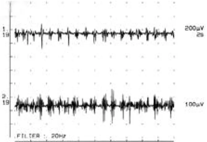 Figure 5. EMG findings of case 4. Electromyography per- per-formed in the lower extremity showed synchronous EMG activity(80%) and alternating EMG activity(20%) between left and right tibialis anterior at various times